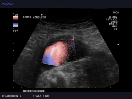 Ultrazvok žil trebuha - anevrizma abdominalne aorte